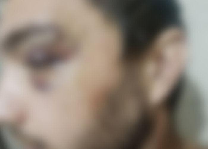 Por causa das agressões, Anderson levou ponto no olho e na boca